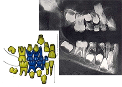 Røntgenbilde av tenner hos sjuåring